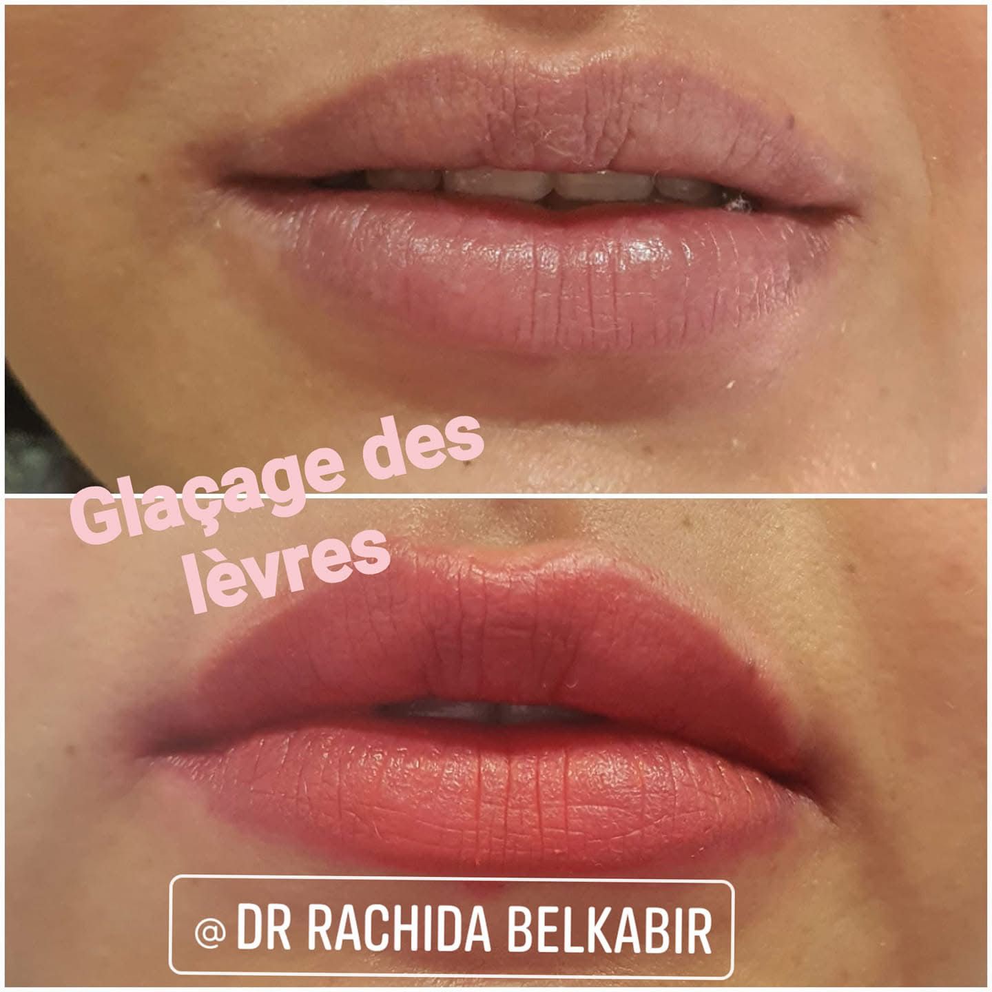Embellir les lèvres - Avant et Après