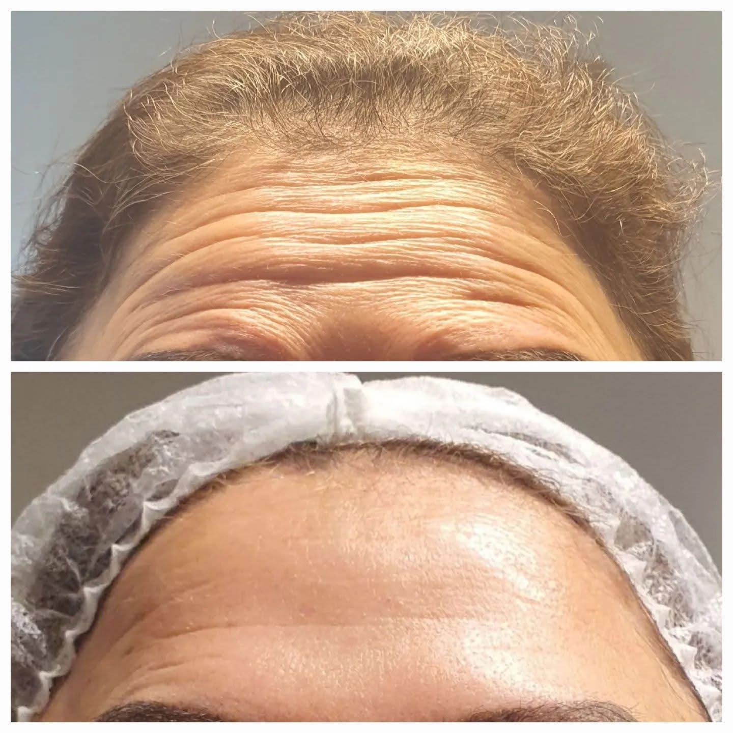 Effacer les rides du front - Avant et Après