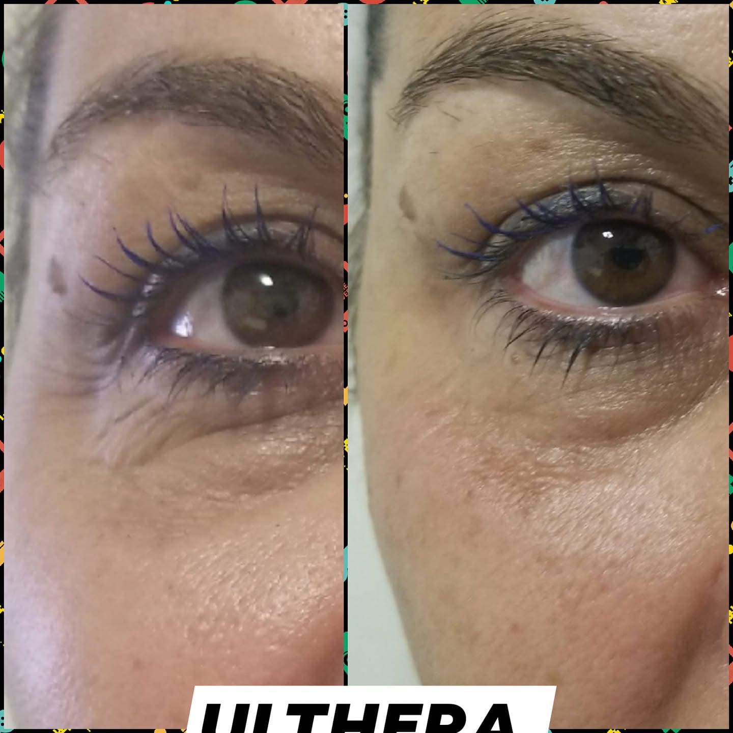 Lifting sans chirurgie - Avant et Après