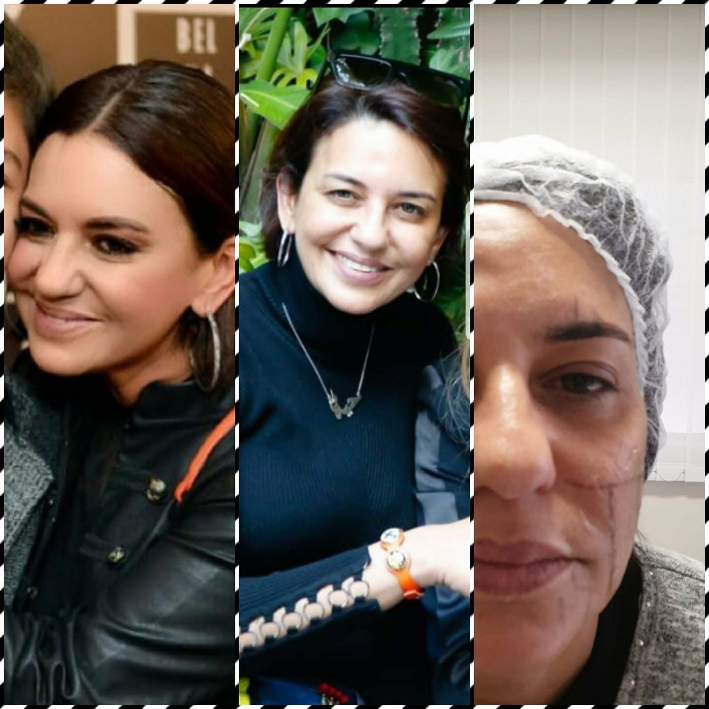 Visage anti-âge - Avant et Après